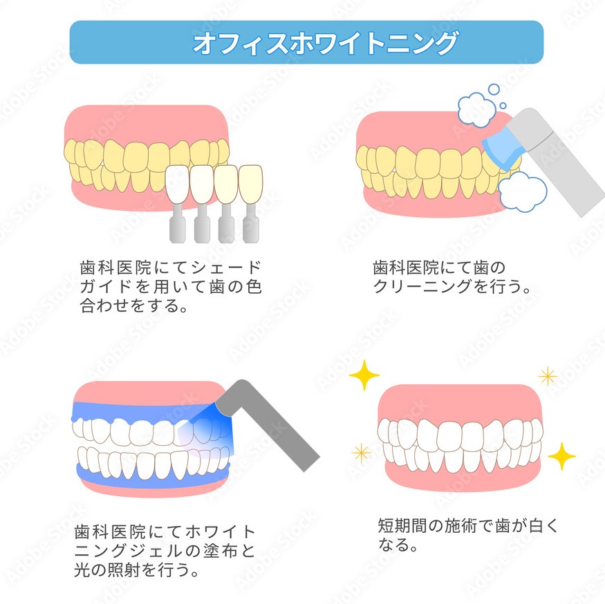 ホワイトニングの種類（Types of tooth whitening) - 王子歯科